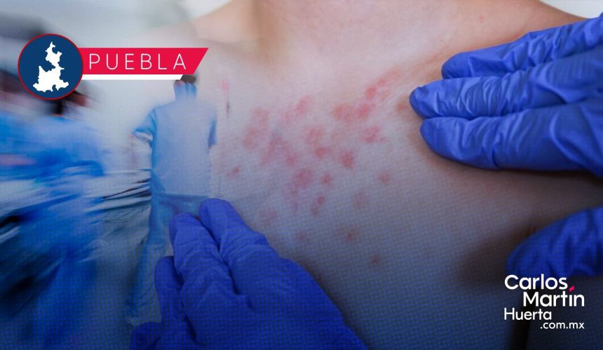 Ya son 95 casos de Sarampión en Puebla; hay 307 probables