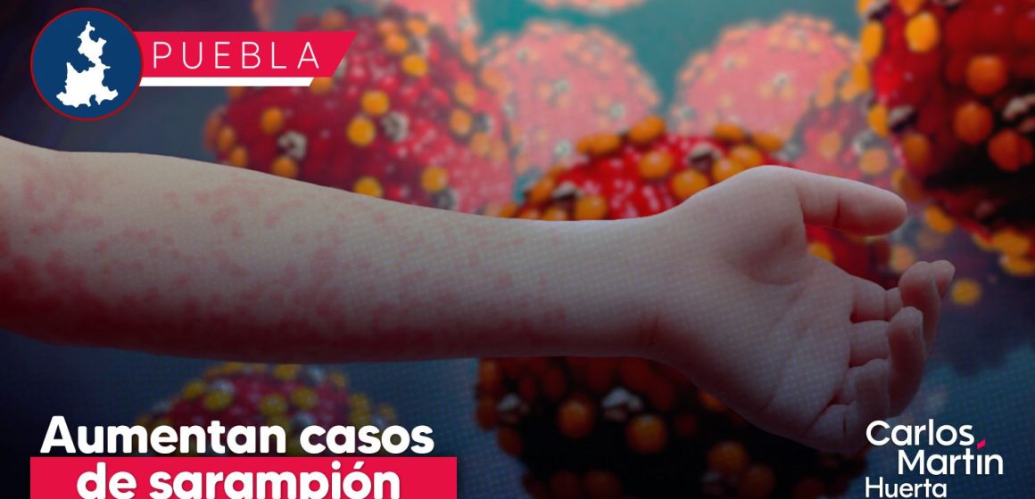 Aumentan casos de sarampión en Puebla: Reportan 38 contagios en 5 municipios