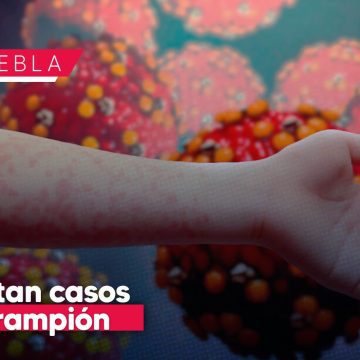 Aumentan casos de sarampión en Puebla: Reportan 38 contagios en 5 municipios