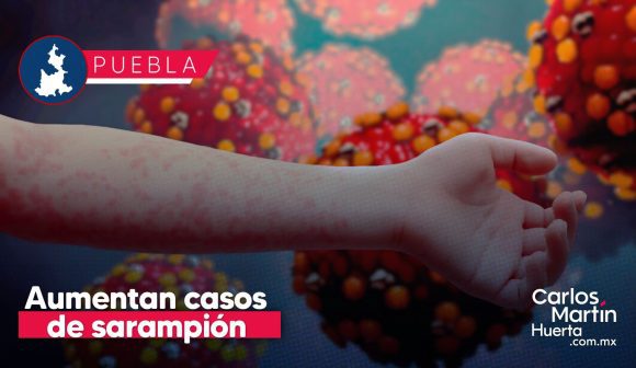 Aumentan casos de sarampión en Puebla: Reportan 38 contagios en 5 municipios