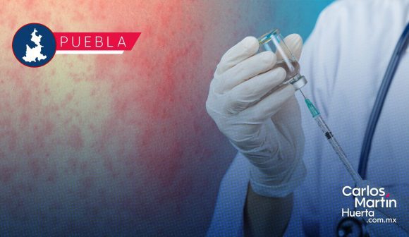 Sarampión en Puebla: 53 casos confirmados en 5 municipios
