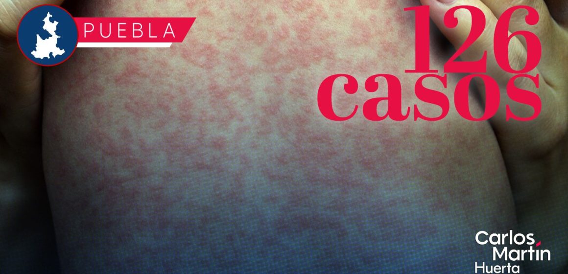 Salud informa que ya son 126 casos de Sarampión en Puebla; 12 en las últimas horas