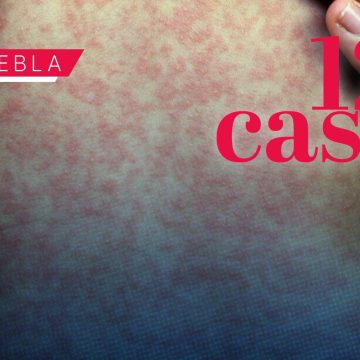 Salud informa que ya son 126 casos de Sarampión en Puebla; 12 en las últimas horas