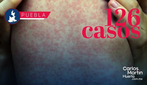 Salud informa que ya son 126 casos de Sarampión en Puebla; 12 en las últimas horas