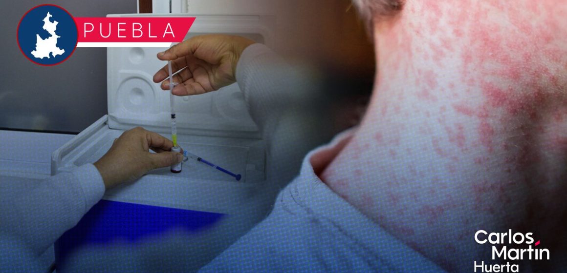 Suman 59 casos de sarampión en Puebla; se extienden a 6 municipios