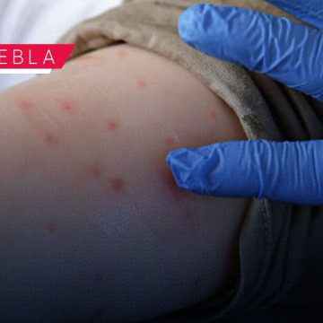 Ya son 102 casos de Sarampión en Puebla; analizan 333 como probables