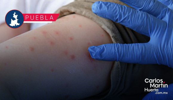 Portada Ya son 102 casos de Sarampión en Puebla; analizan 333 como probables CMH Ya son 102 casos de Sarampión en Puebla; analizan 333 como probables