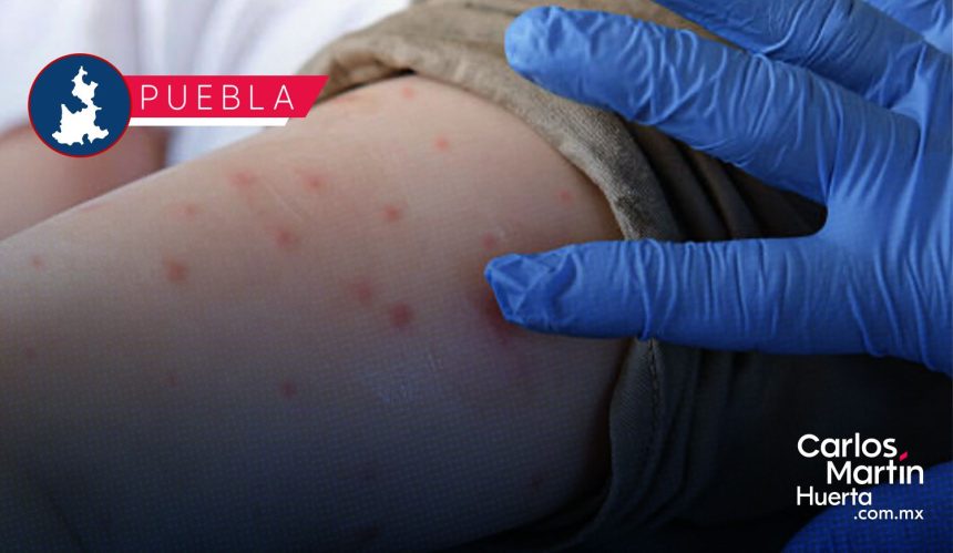 Ya son 102 casos de Sarampión en Puebla; analizan 333 como probables