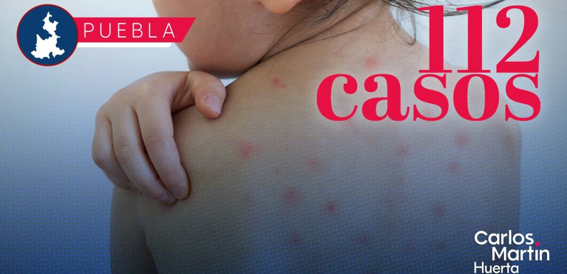 Ya son 112 casos de Sarampión en Puebla; analizan 344 como probables