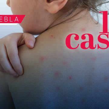 Ya son 112 casos de Sarampión en Puebla; analizan 344 como probables