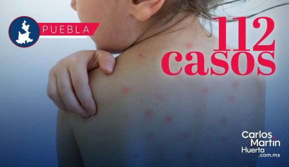 Portada Ya son 112 casos de Sarampión en Puebla; analizan 344 como probables CMH Ya son 112 casos de Sarampión en Puebla; analizan 344 como probables