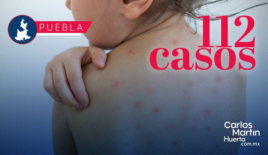 Ya son 112 casos de Sarampión en Puebla; analizan 344 como probables