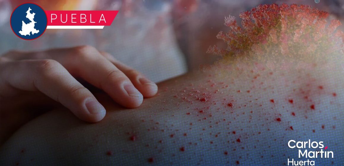 Ya son 40 casos de Sarampión en Puebla