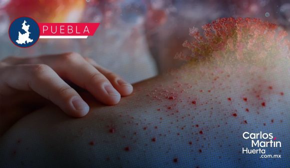 Ya son 40 casos de Sarampión en Puebla