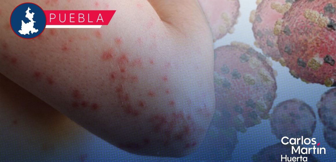 Ya son 45 contagios de Sarampión en Puebla; hay 174 casos probables