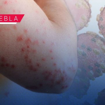 Ya son 45 contagios de Sarampión en Puebla; hay 174 casos probables