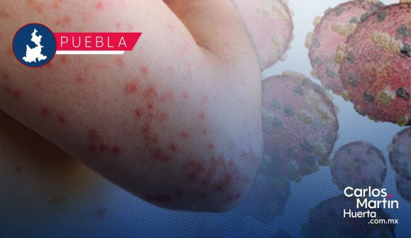 Ya son 45 contagios de Sarampión en Puebla; hay 174 casos probables