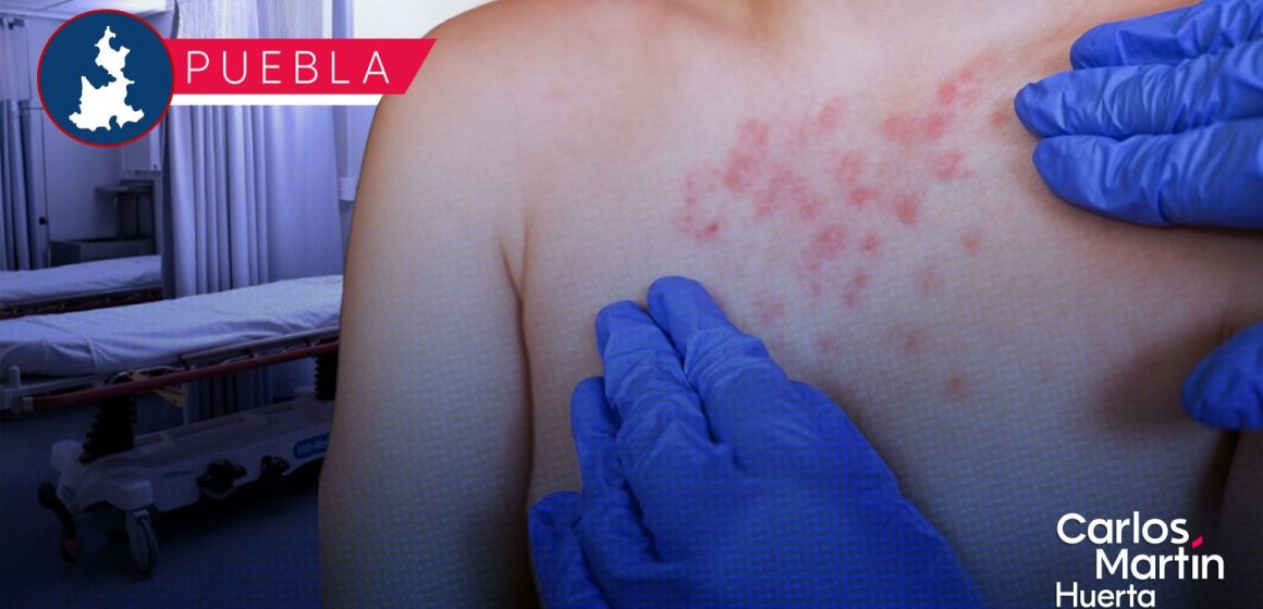 Ya son 68 casos de Sarampión en Puebla; tiene presencia en 8 municipios