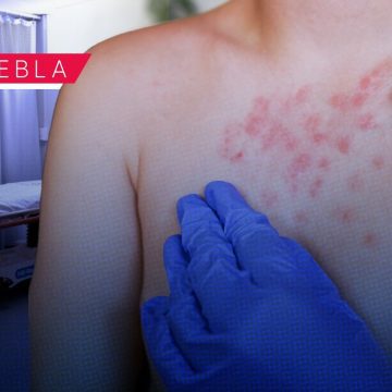 Ya son 68 casos de Sarampión en Puebla; tiene presencia en 8 municipios