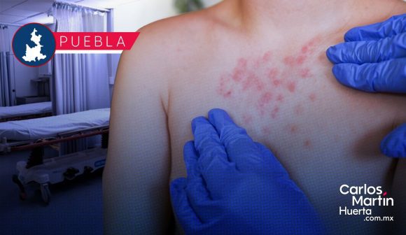 Ya son 68 casos de Sarampión en Puebla; tiene presencia en 8 municipios