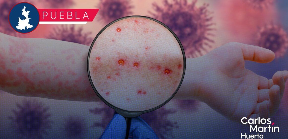 Portada Ya son 82 casos de Sarampión en Puebla; lugar 11 a nivel nacional en contagios CMH Ya son 82 casos de Sarampión en Puebla; lugar 11 a nivel nacional en contagios