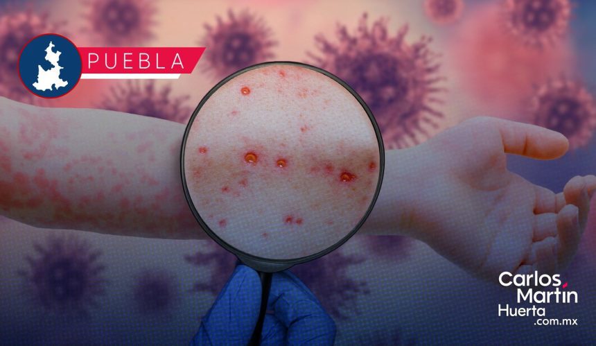 Ya son 82 casos de Sarampión en Puebla; lugar 11 a nivel nacional en contagios