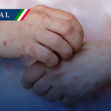 México supera los 2 mil casos de sarampión en 2026
