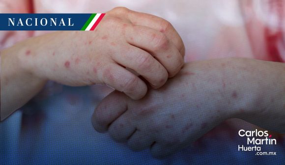 Sarampión en México: Salud aclara que el repunte es un fenómeno global post-pandemia