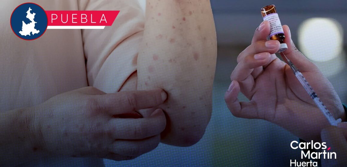Sarampión en Puebla: Salud Federal reporta 152 casos; refuerzan cercos sanitarios en 12 municipios