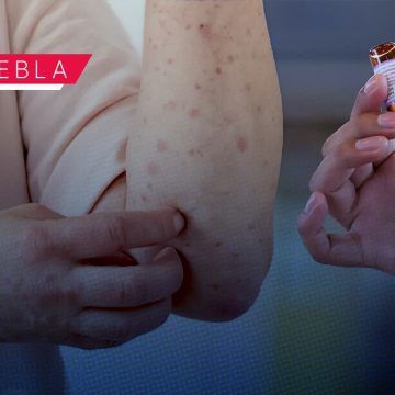 Sarampión en Puebla: Salud Federal reporta 152 casos; refuerzan cercos sanitarios en 12 municipios