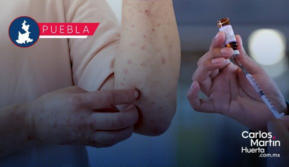 Sarampión en Puebla: Salud Federal reporta 152 casos; refuerzan cercos sanitarios en 12 municipios