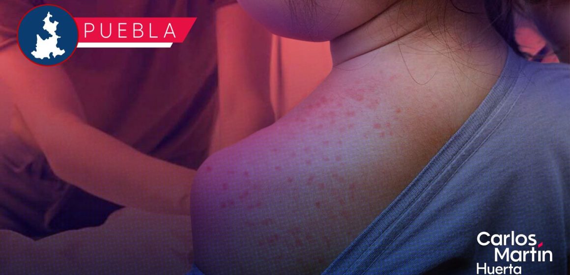 Sarampión en Puebla: Reportan 157 casos confirmados en 14 municipios; vigilancia se extiende por 405 casos probables