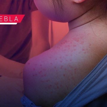 Sarampión en Puebla: Reportan 157 casos confirmados en 14 municipios; vigilancia se extiende por 405 casos probables