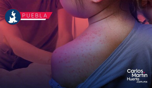 Sarampión en Puebla: Reportan 157 casos confirmados en 14 municipios; vigilancia se extiende por 405 casos probables