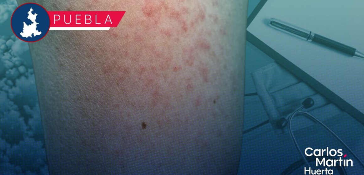 Sarampión no da tregua en Puebla: Ya son 165 contagios y el virus llega a 15 municipios