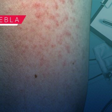 Sarampión no da tregua en Puebla: Ya son 165 contagios y el virus llega a 15 municipios