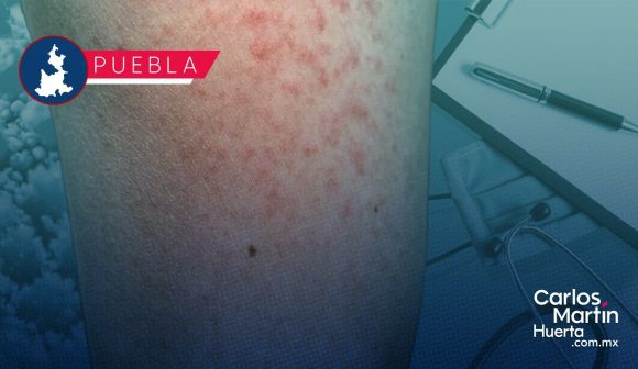 Sarampión no da tregua en Puebla: Ya son 165 contagios y el virus llega a 15 municipios