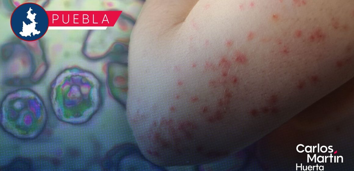 Sarampión en Puebla: Casos confirmados suben a 168; vigilancia médica se extiende a 420 sospechosos