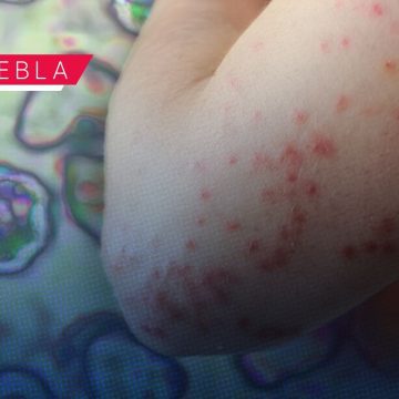 Sarampión en Puebla: Casos confirmados suben a 168; vigilancia médica se extiende a 420 sospechosos