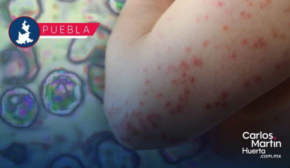Sarampión en Puebla: Casos confirmados suben a 168; vigilancia médica se extiende a 420 sospechosos