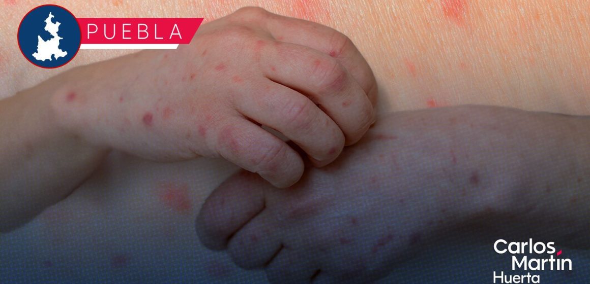 Sarampión en Puebla: Reportan paridad de contagios entre hombres y mujeres; suman 174 casos