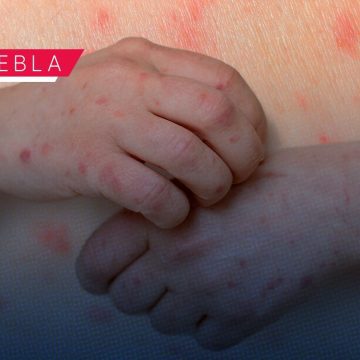 Sarampión en Puebla: Reportan paridad de contagios entre hombres y mujeres; suman 174 casos