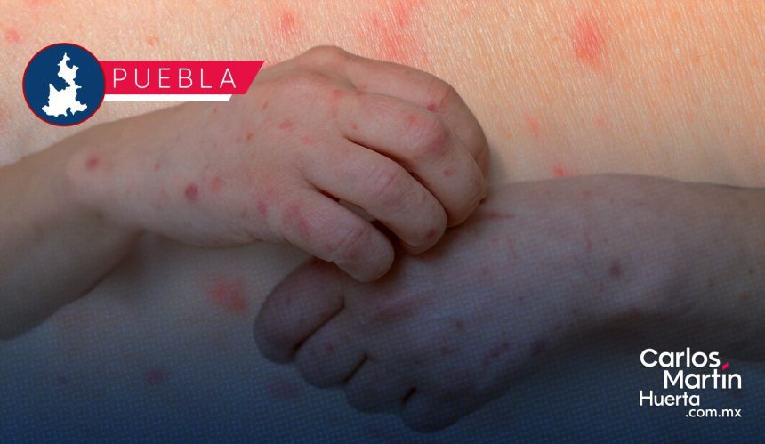 Sarampión en Puebla: Reportan paridad de contagios entre hombres y mujeres; suman 174 casos