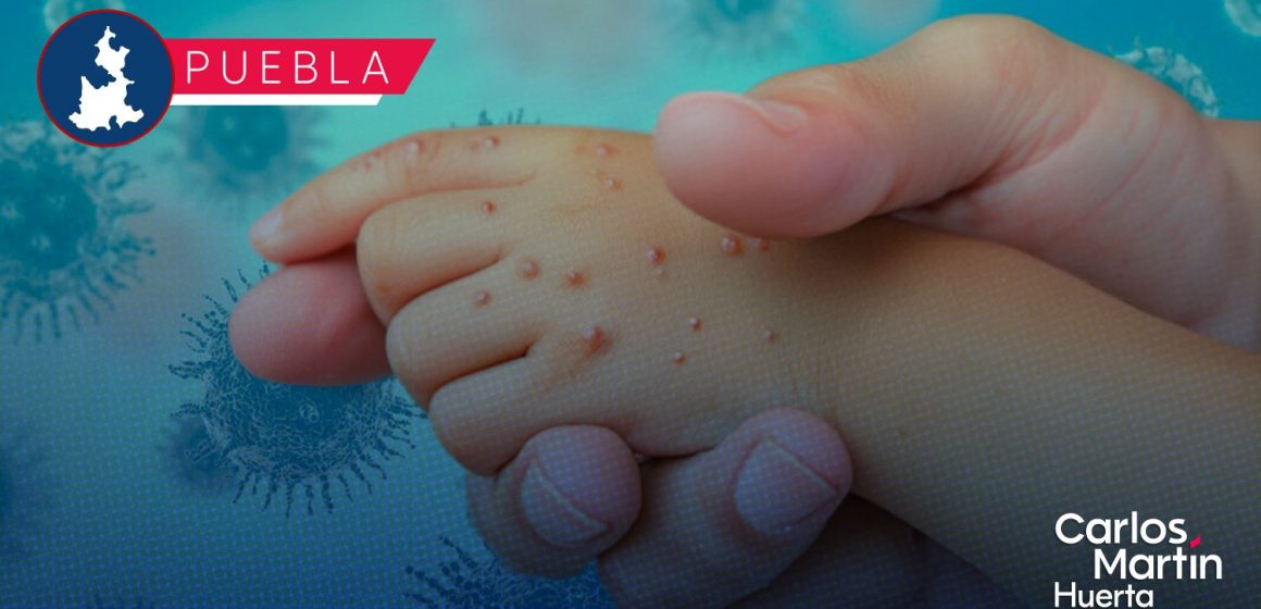 Sarampión en Puebla: Casos confirmados suben a 180; hay 438 personas bajo sospecha