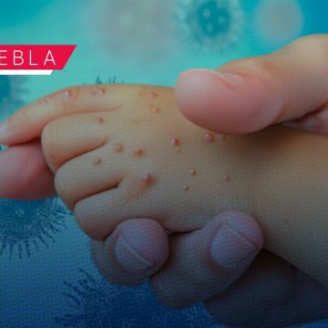 Sarampión en Puebla: Casos confirmados suben a 180; hay 438 personas bajo sospecha