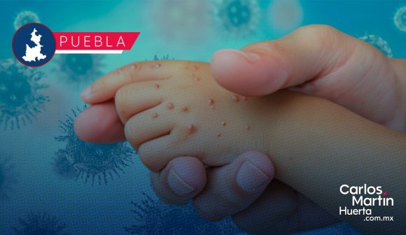 Sarampión en Puebla: Casos confirmados suben a 180; hay 438 personas bajo sospecha