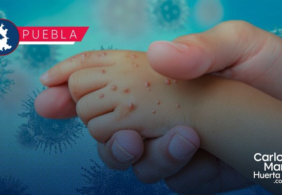 Sarampión en Puebla: Casos confirmados suben a 180; hay 438 personas bajo sospecha