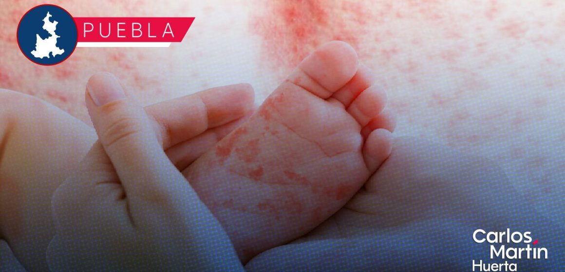 Sarampión llega a 17 municipios de Puebla; suman 196 casos positivos