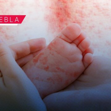 Sarampión llega a 17 municipios de Puebla; suman 196 casos positivos