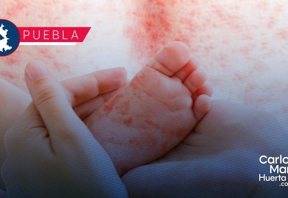 Sarampión llega a 17 municipios de Puebla; suman 196 casos positivos